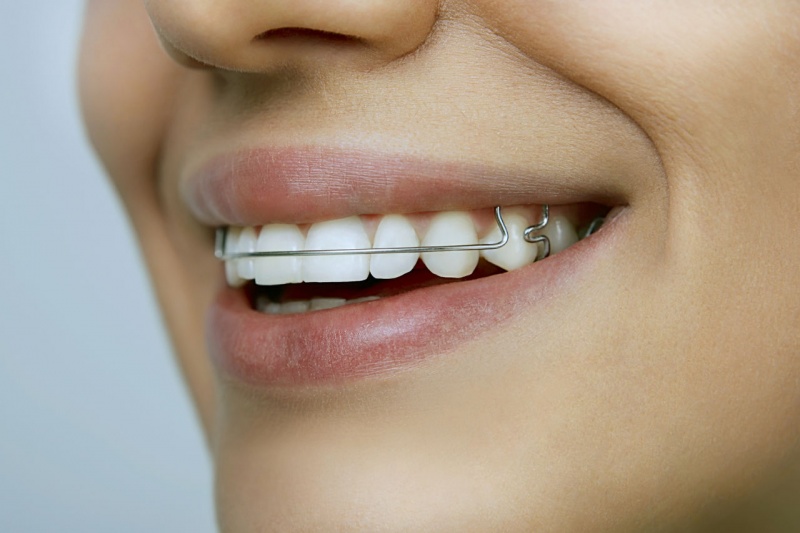 Исправление прикуса зубов быстро и качественно в «Стоматологии 32»